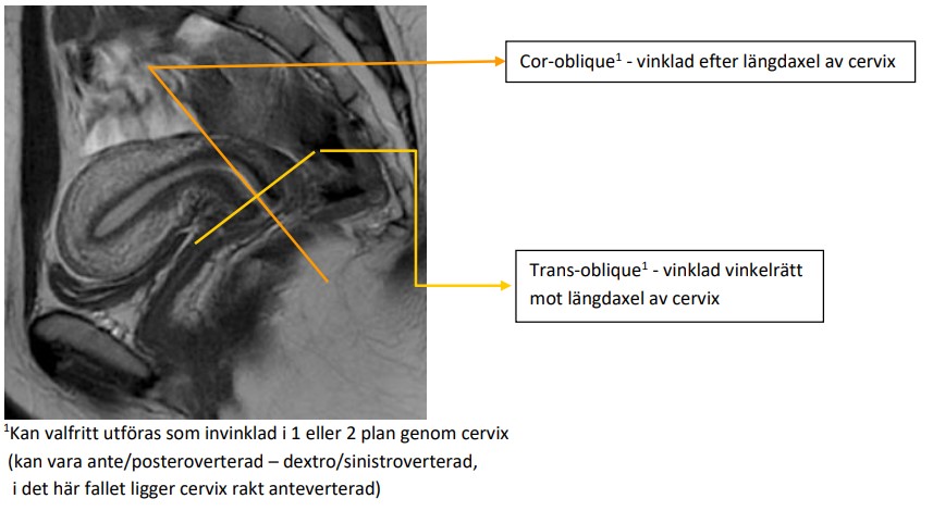 Bild vinklingsexempel för cor resp tra obl av cervix